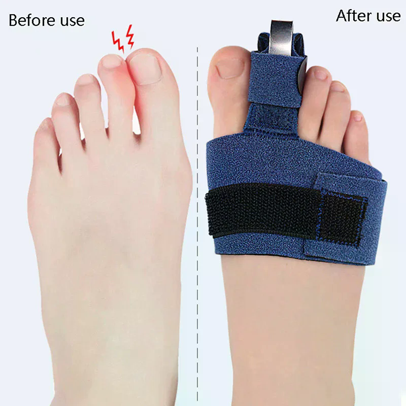 1Pcs Toe Corrector Toe Fractur - Ankle Brace Sock ulasan dan harga